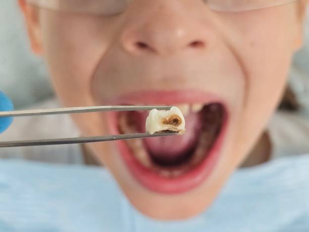 Best Emergency Dental Care for Abscessed Tooth in Eatonville, FL